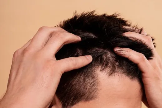 Hair Fall & Thinning